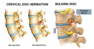 Read more about the article Disc Herniation Treatment in Bangladesh