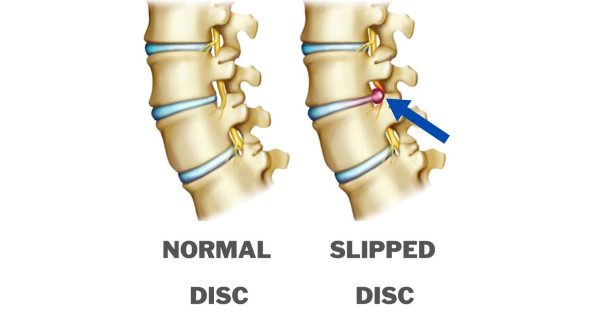 Read more about the article Slip Disc Physiotherapy in Dhaka